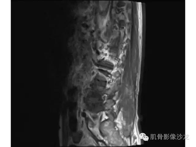 【病例】布氏杆菌脊柱炎1例MR影像讨论 【病例】布氏杆菌脊柱炎1例MR影像讨论