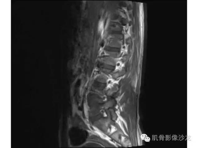 【病例】布氏杆菌脊柱炎1例MR影像讨论 【病例】布氏杆菌脊柱炎1例MR影像讨论