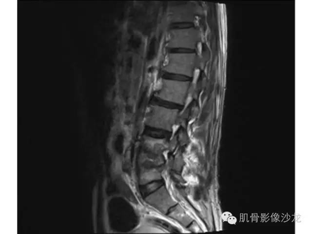 【病例】布氏杆菌脊柱炎1例MR影像讨论 【病例】布氏杆菌脊柱炎1例MR影像讨论