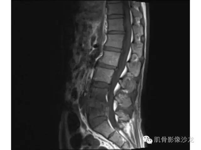 【病例】布氏杆菌脊柱炎1例MR影像讨论 【病例】布氏杆菌脊柱炎1例MR影像讨论