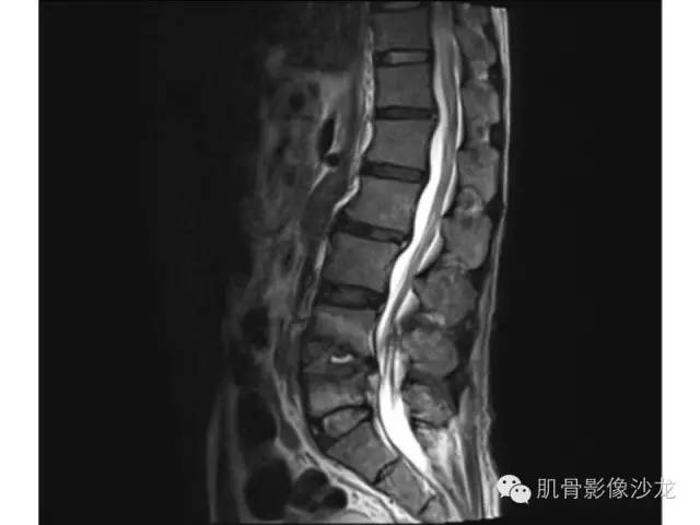 【病例】布氏杆菌脊柱炎1例MR影像讨论 【病例】布氏杆菌脊柱炎1例MR影像讨论