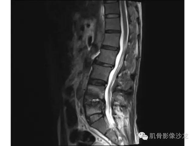 【病例】布氏杆菌脊柱炎1例MR影像讨论 【病例】布氏杆菌脊柱炎1例MR影像讨论