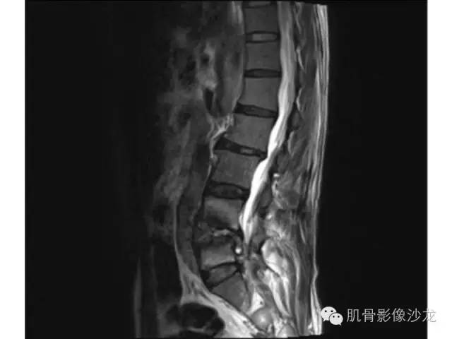 【病例】布氏杆菌脊柱炎1例MR影像讨论 【病例】布氏杆菌脊柱炎1例MR影像讨论