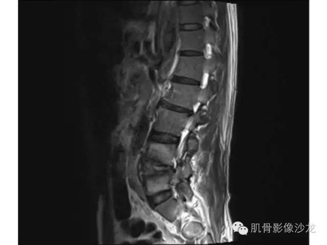 【病例】布氏杆菌脊柱炎1例MR影像讨论 【病例】布氏杆菌脊柱炎1例MR影像讨论