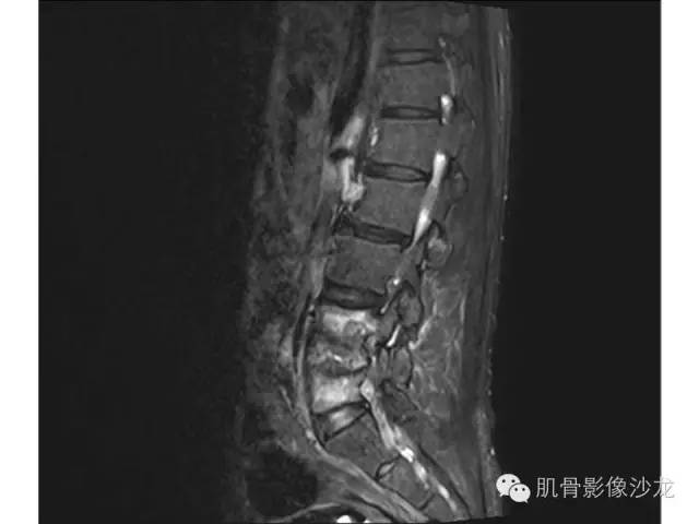 【病例】布氏杆菌脊柱炎1例MR影像讨论 【病例】布氏杆菌脊柱炎1例MR影像讨论