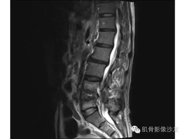 【病例】布氏杆菌脊柱炎1例MR影像讨论 【病例】布氏杆菌脊柱炎1例MR影像讨论