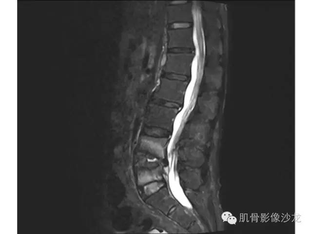 【病例】布氏杆菌脊柱炎1例MR影像讨论 【病例】布氏杆菌脊柱炎1例MR影像讨论