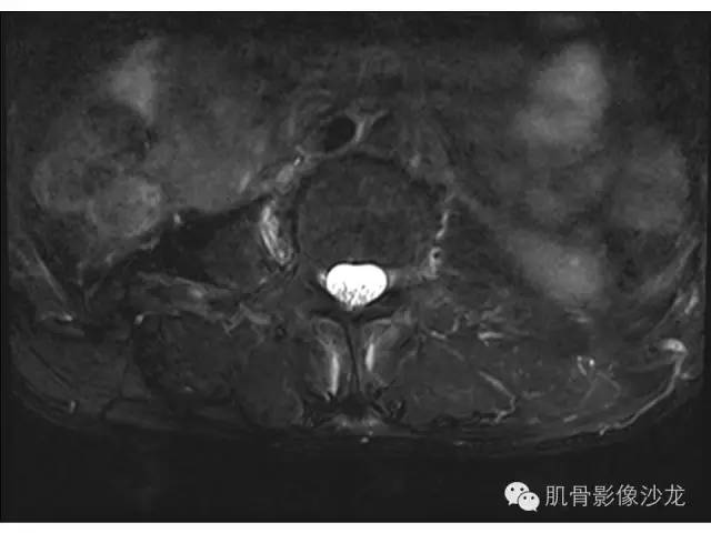 【病例】布氏杆菌脊柱炎1例MR影像讨论 【病例】布氏杆菌脊柱炎1例MR影像讨论