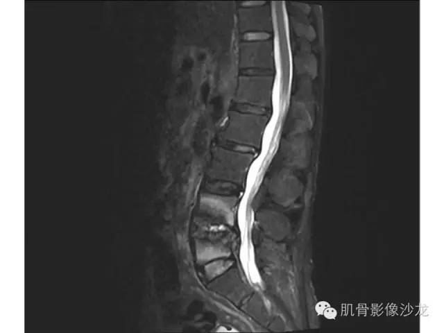 【病例】布氏杆菌脊柱炎1例MR影像讨论 【病例】布氏杆菌脊柱炎1例MR影像讨论