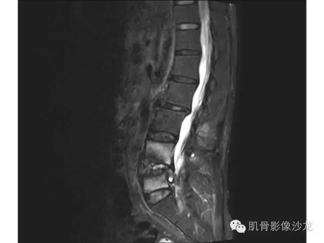 【病例】布氏杆菌脊柱炎1例MR影像讨论 【病例】布氏杆菌脊柱炎1例MR影像讨论
