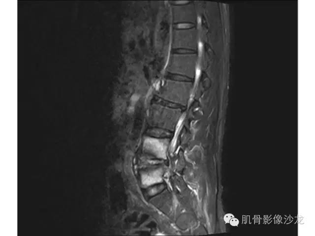 【病例】布氏杆菌脊柱炎1例MR影像讨论 【病例】布氏杆菌脊柱炎1例MR影像讨论