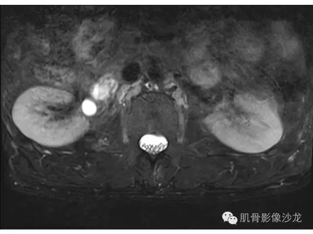 【病例】布氏杆菌脊柱炎1例MR影像讨论 【病例】布氏杆菌脊柱炎1例MR影像讨论
