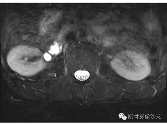 【病例】布氏杆菌脊柱炎1例MR影像讨论 【病例】布氏杆菌脊柱炎1例MR影像讨论