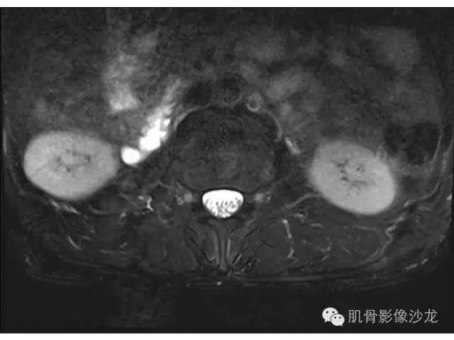【病例】布氏杆菌脊柱炎1例MR影像讨论 【病例】布氏杆菌脊柱炎1例MR影像讨论