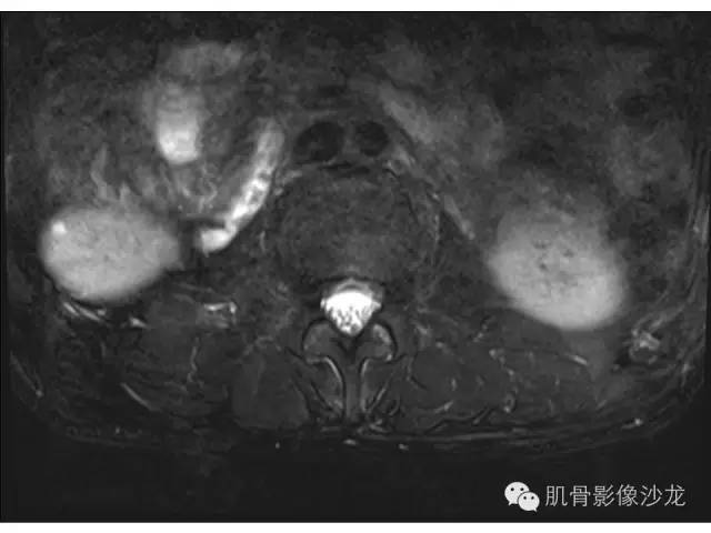 【病例】布氏杆菌脊柱炎1例MR影像讨论 【病例】布氏杆菌脊柱炎1例MR影像讨论