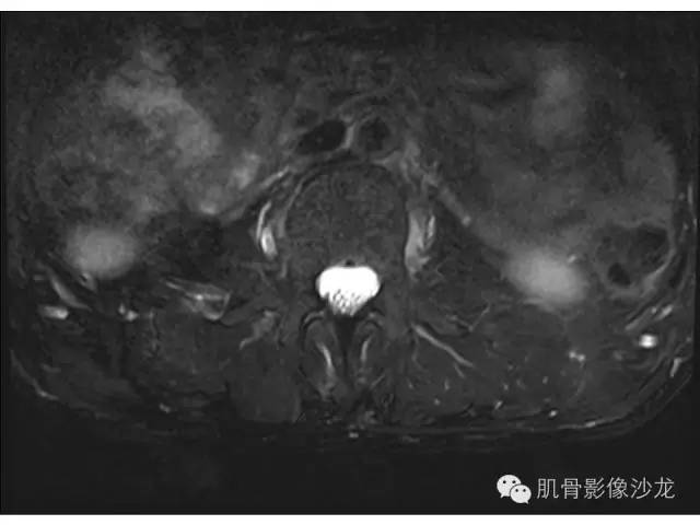 【病例】布氏杆菌脊柱炎1例MR影像讨论 【病例】布氏杆菌脊柱炎1例MR影像讨论