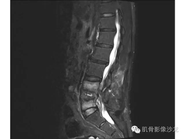 【病例】布氏杆菌脊柱炎1例MR影像讨论 【病例】布氏杆菌脊柱炎1例MR影像讨论