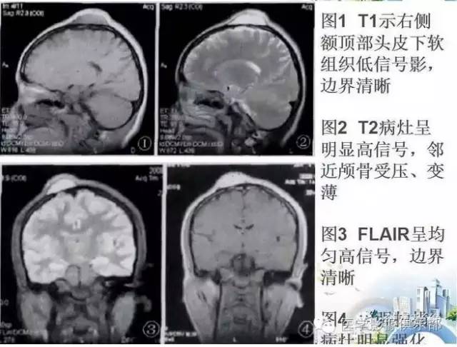 颅骨膜血窦