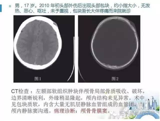 颅骨膜血窦 颅骨膜血窦