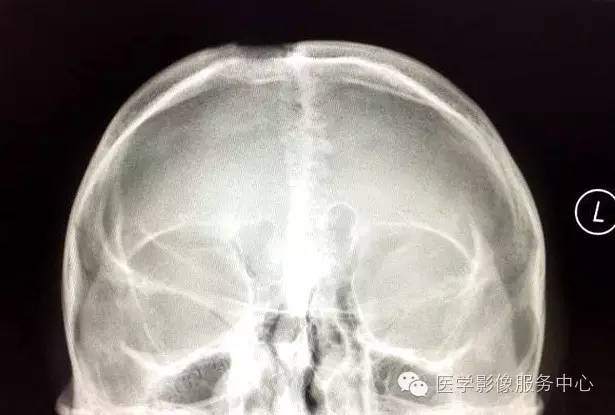 【病例】颅骨血管瘤1例CT及MR影像表现