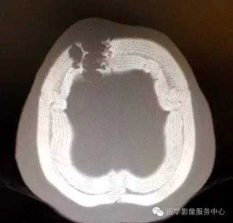 【病例】颅骨血管瘤1例CT及MR影像表现