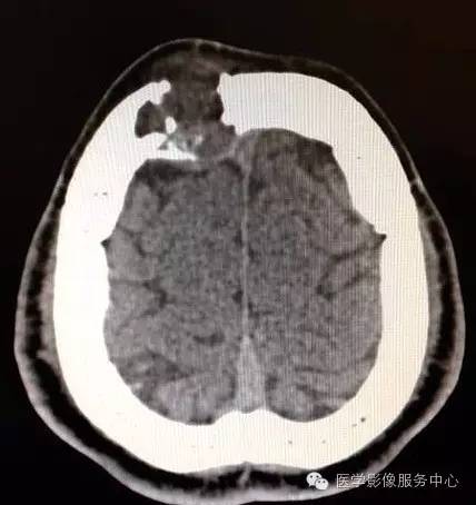 【病例】颅骨血管瘤1例CT及MR影像表现