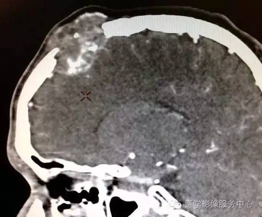 【病例】颅骨血管瘤1例CT及MR影像表现