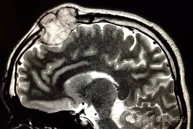 【病例】颅骨血管瘤1例CT及MR影像表现