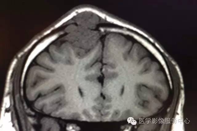 【病例】颅骨血管瘤1例CT及MR影像表现