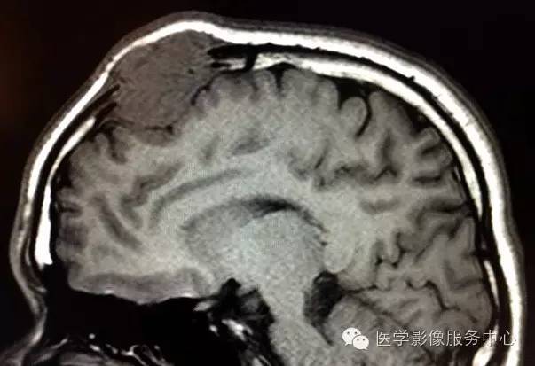 【病例】颅骨血管瘤1例CT及MR影像表现
