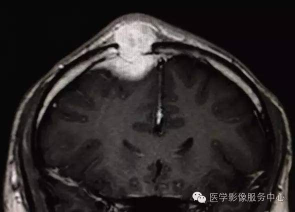 【病例】颅骨血管瘤1例CT及MR影像表现