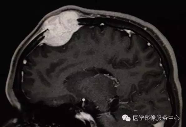【病例】颅骨血管瘤1例CT及MR影像表现
