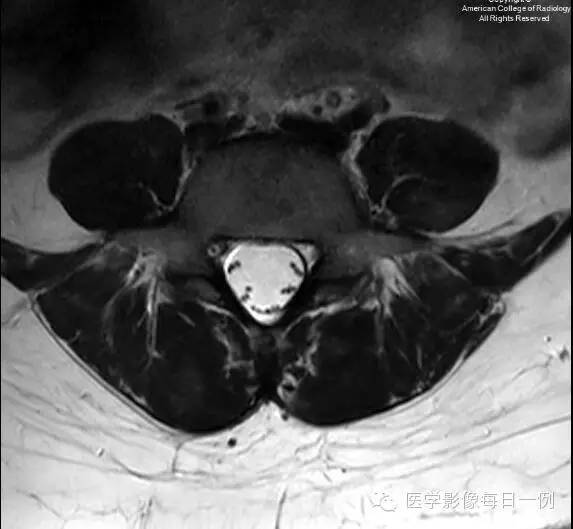 【病例】椎旁肌化脓性肌炎1例MR影像表现