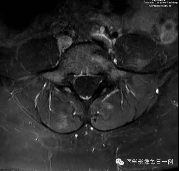 【病例】椎旁肌化脓性肌炎1例MR影像表现 【病例】椎旁肌化脓性肌炎1例MR影像表现