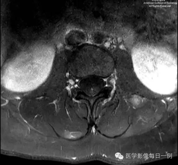 【病例】椎旁肌化脓性肌炎1例MR影像表现 【病例】椎旁肌化脓性肌炎1例MR影像表现