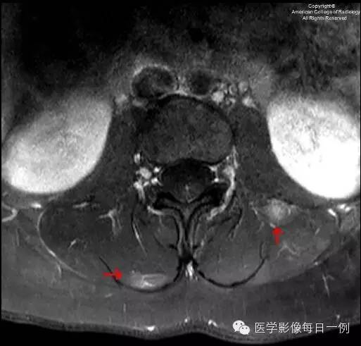【病例】椎旁肌化脓性肌炎1例MR影像表现 【病例】椎旁肌化脓性肌炎1例MR影像表现