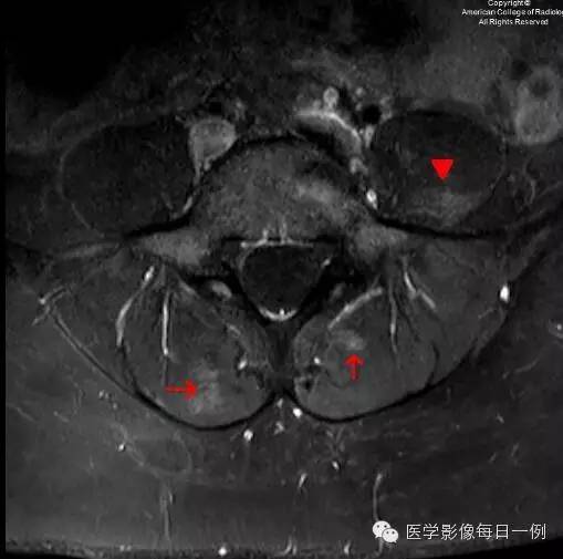 【病例】椎旁肌化脓性肌炎1例MR影像表现 【病例】椎旁肌化脓性肌炎1例MR影像表现