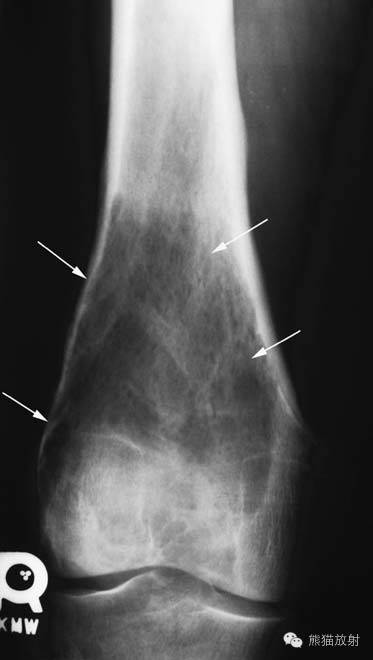 膝关节、胫腓骨——临床影像示例