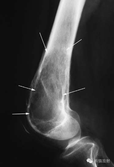 膝关节、胫腓骨——临床影像示例