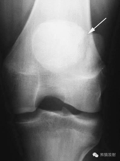 膝关节、胫腓骨——临床影像示例