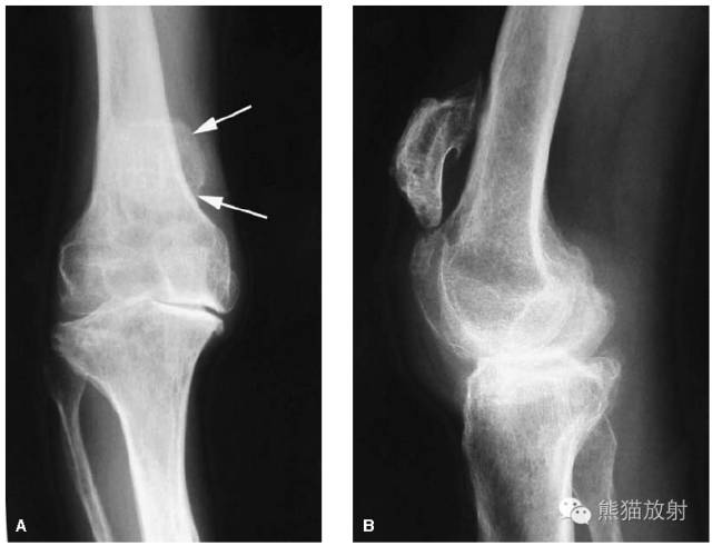 膝关节、胫腓骨——临床影像示例