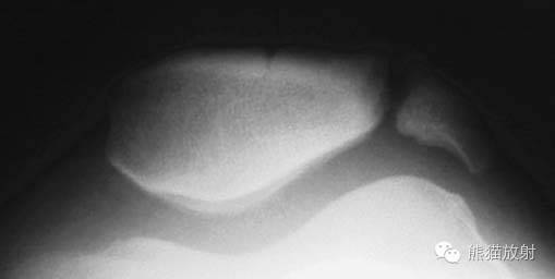 膝关节、胫腓骨——临床影像示例