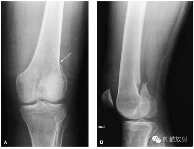 膝关节、胫腓骨——临床影像示例
