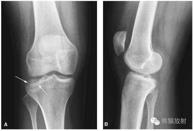 膝关节、胫腓骨——临床影像示例