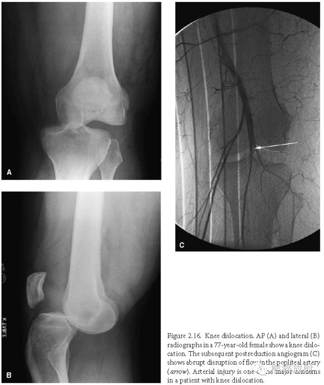 膝关节、胫腓骨——临床影像示例