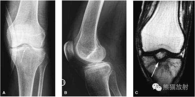 膝关节、胫腓骨——临床影像示例
