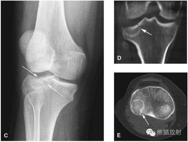 膝关节、胫腓骨——临床影像示例
