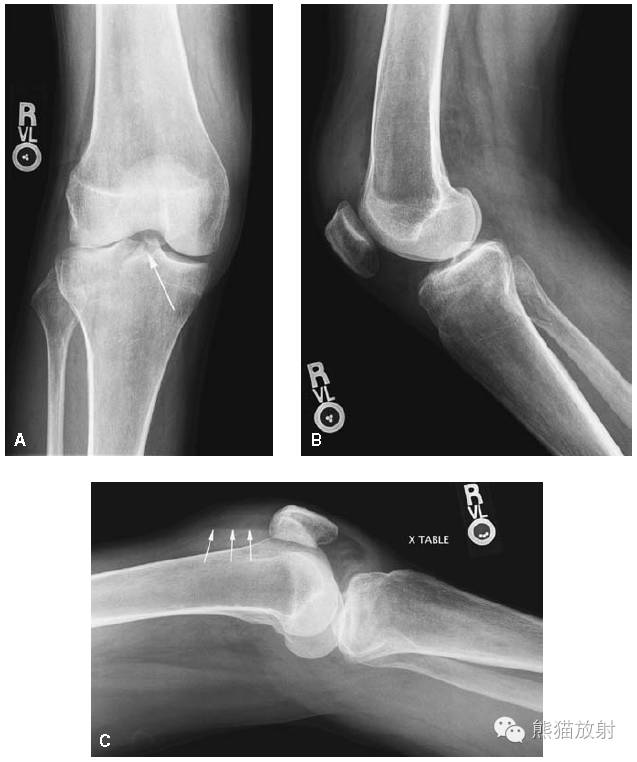 膝关节、胫腓骨——临床影像示例