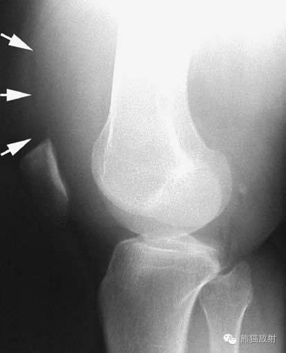膝关节、胫腓骨——临床影像示例