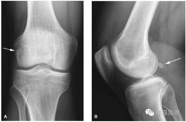 膝关节、胫腓骨——临床影像示例